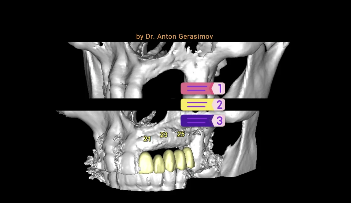 Bone grafting procedure