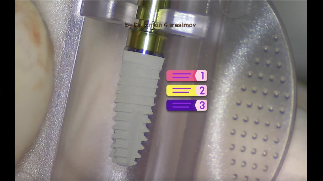 Dental implantation procedure