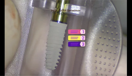 Dental implantation procedure