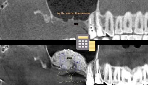 Sinus lift cost
