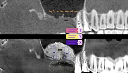 Sinus lift procedure
