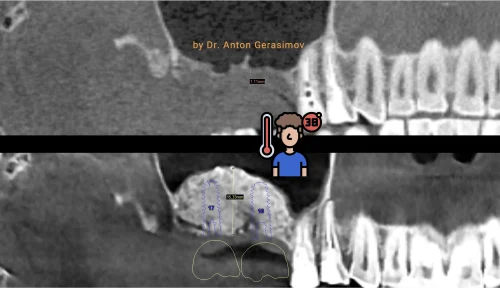 Sinus lift symptoms