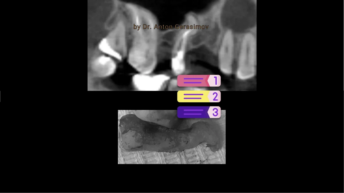 Tooth extraction procedure